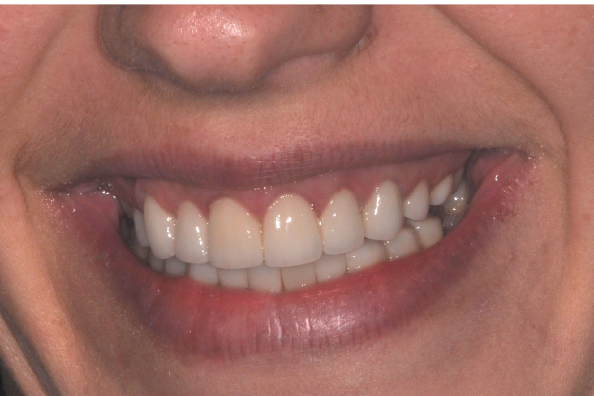 dental crowns pakenham