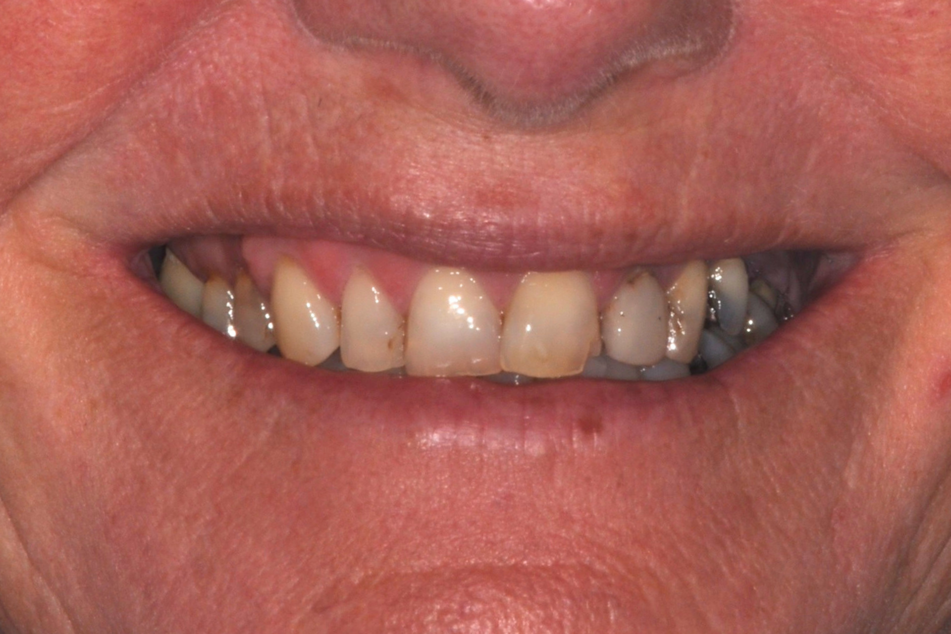 dental crowns pakenham