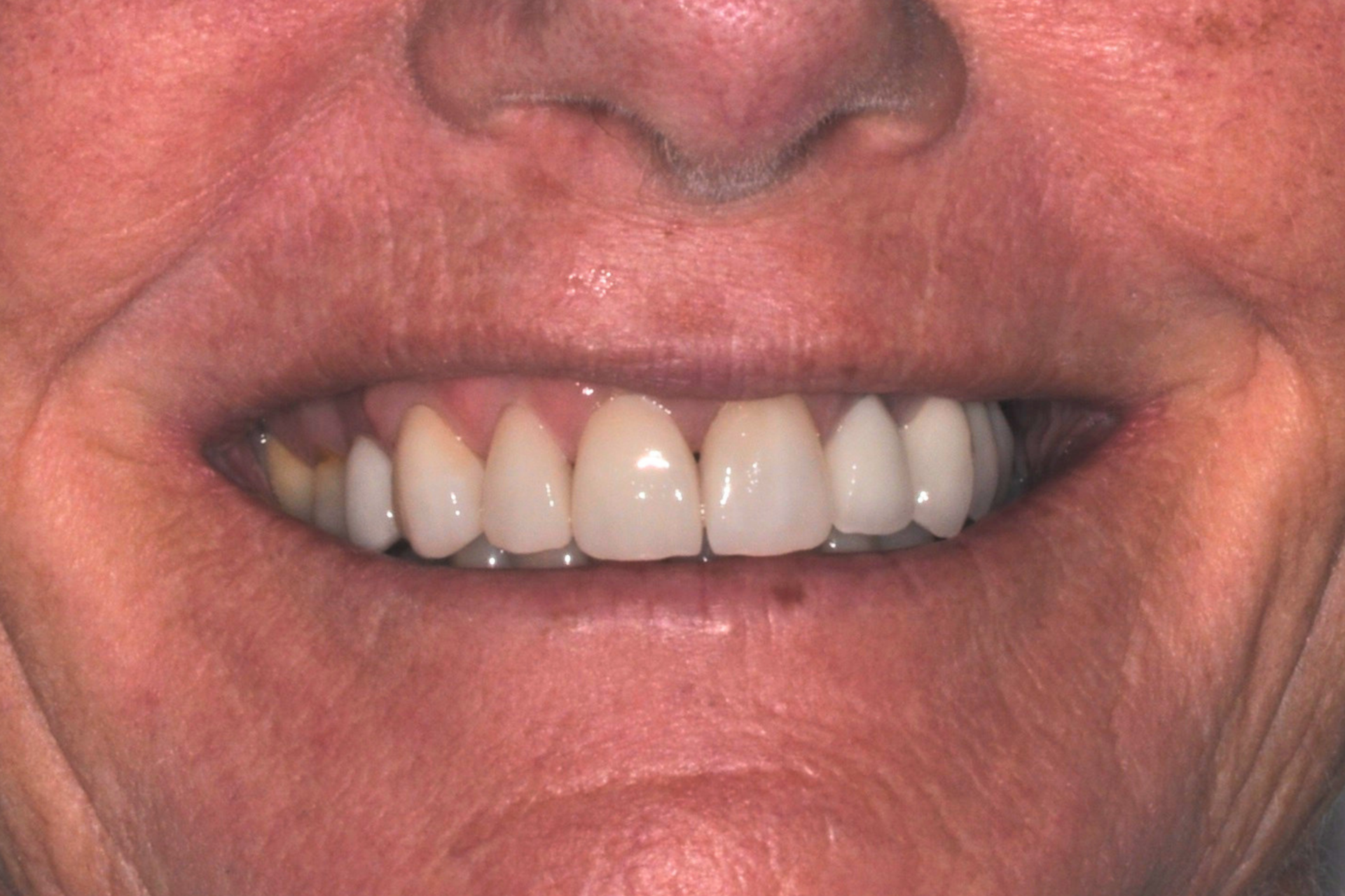 dental crowns pakenham