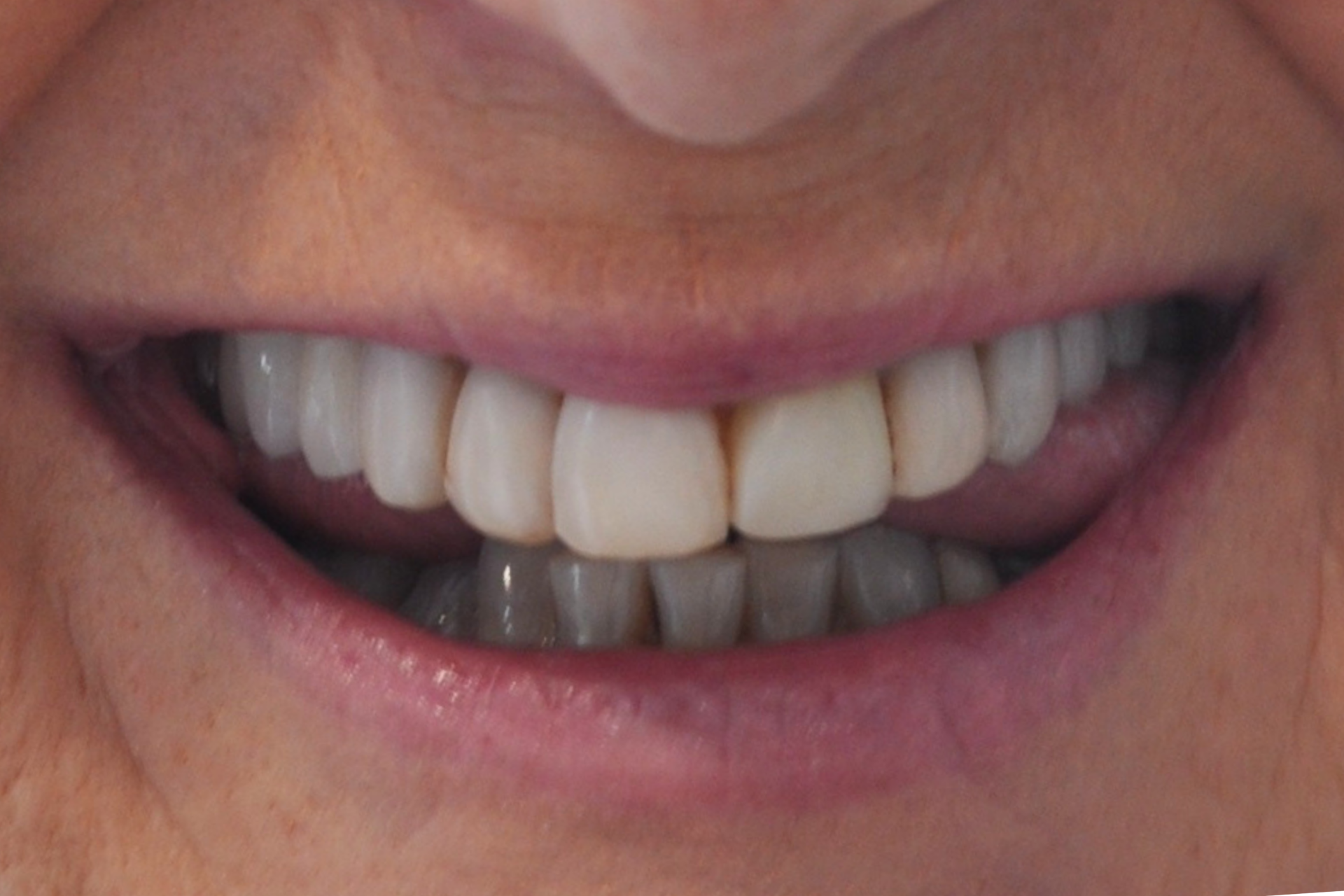 Dental veneers pakenham
