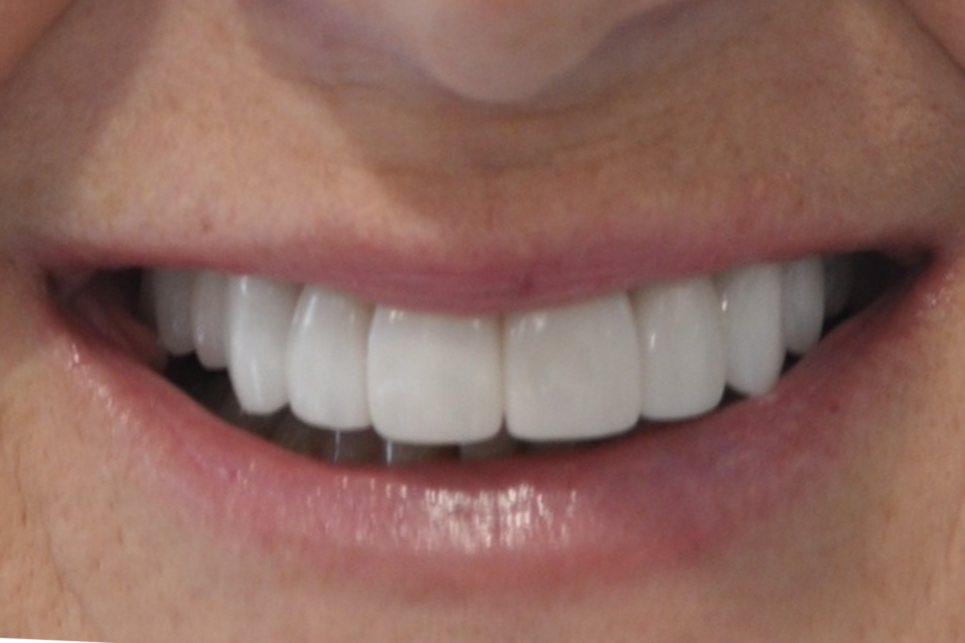 Dental veneers pakenham