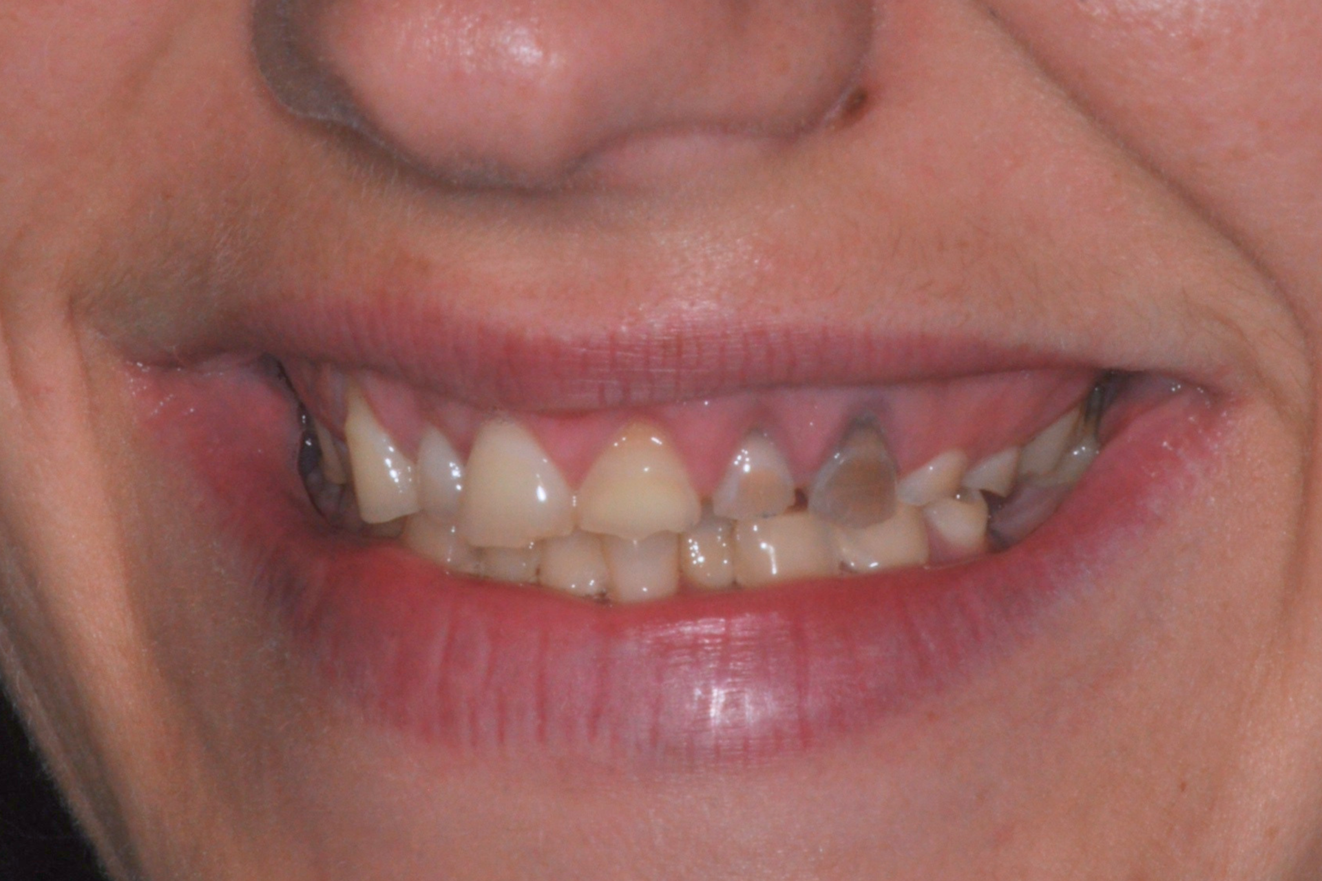 dental crowns pakenham