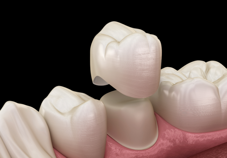 dental crowns at Integrated Dental Care