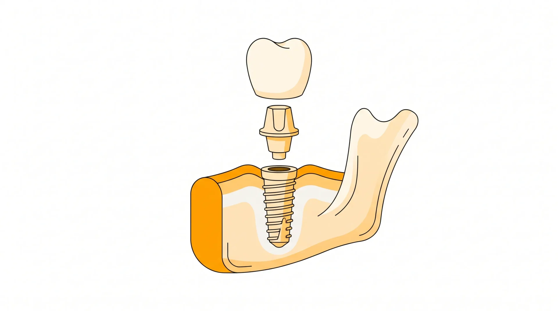 A dental implant is shown in three parts above a jaw segment, illustrating the crown, abutment and fixture.