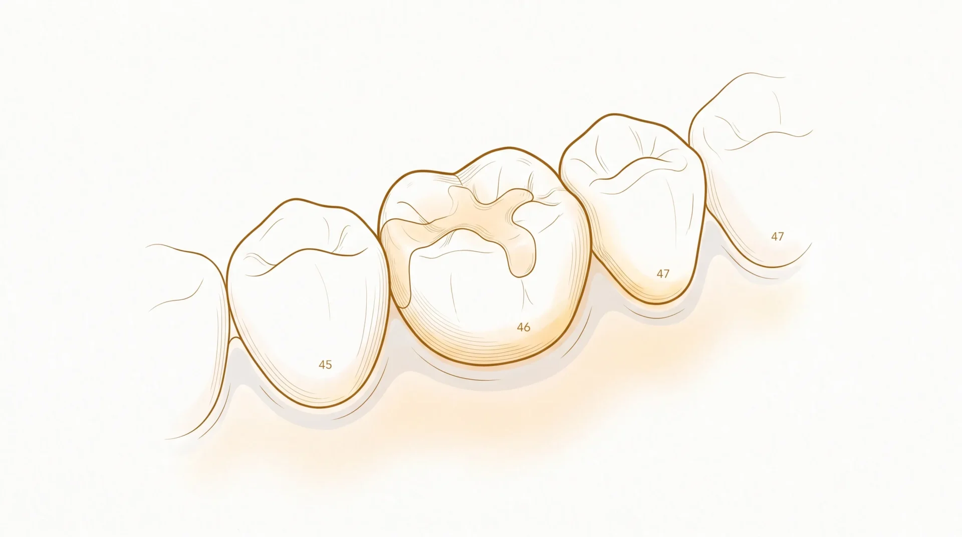 A restored back molar sits between neighbouring teeth and healthy gums, showing a routine tooth repair inside the mouth.