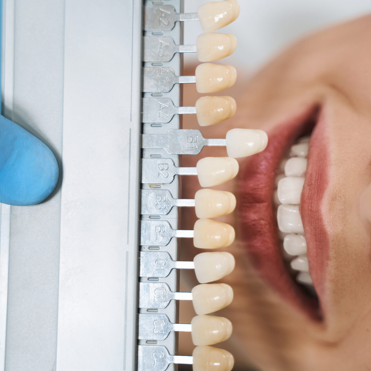 teeth whitening pakenham