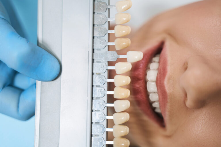 teeth whitening pakenham