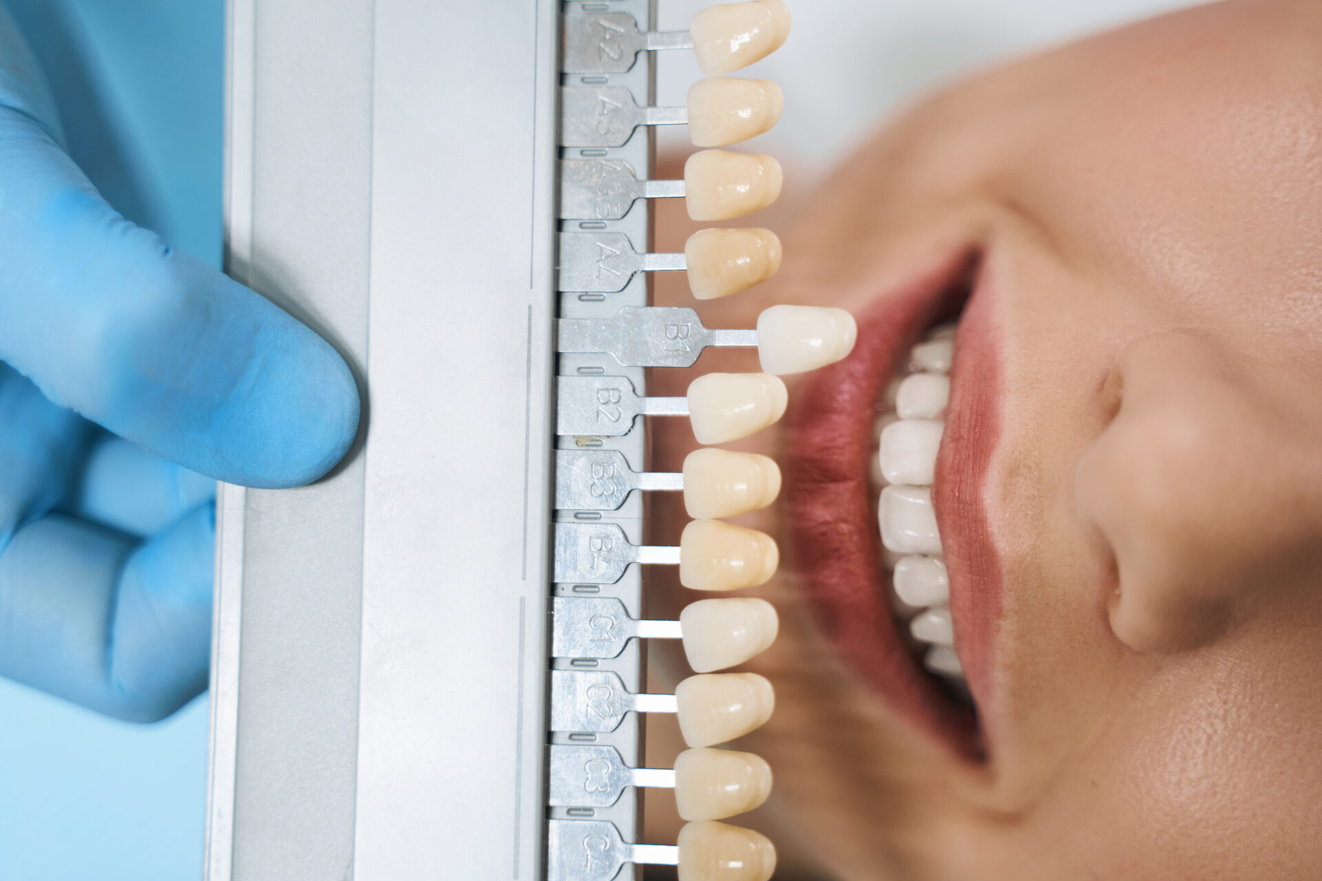teeth whitening pakenham