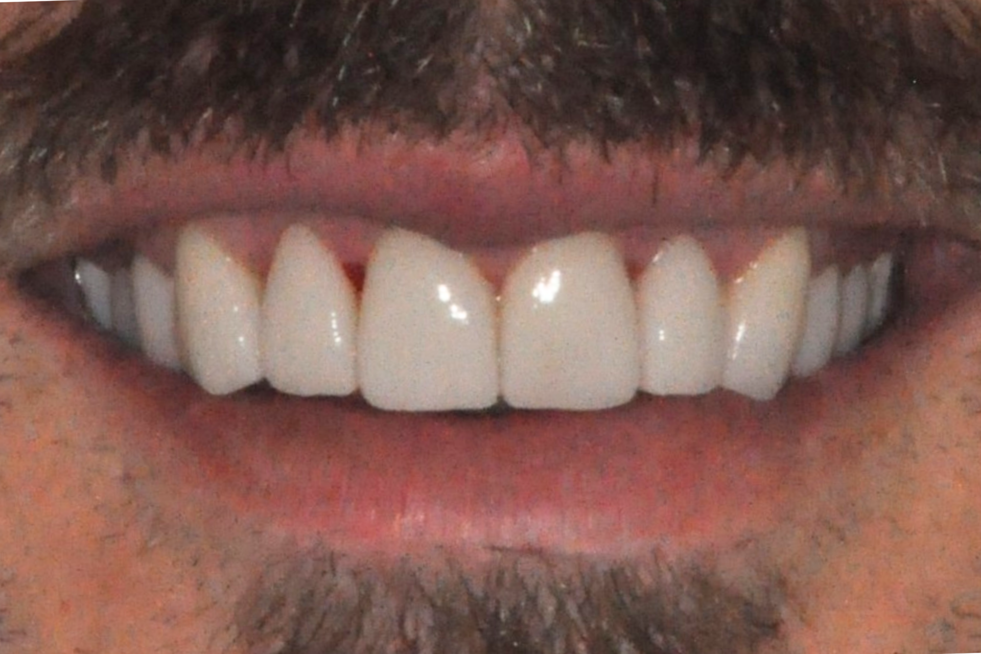 veneers pakenham