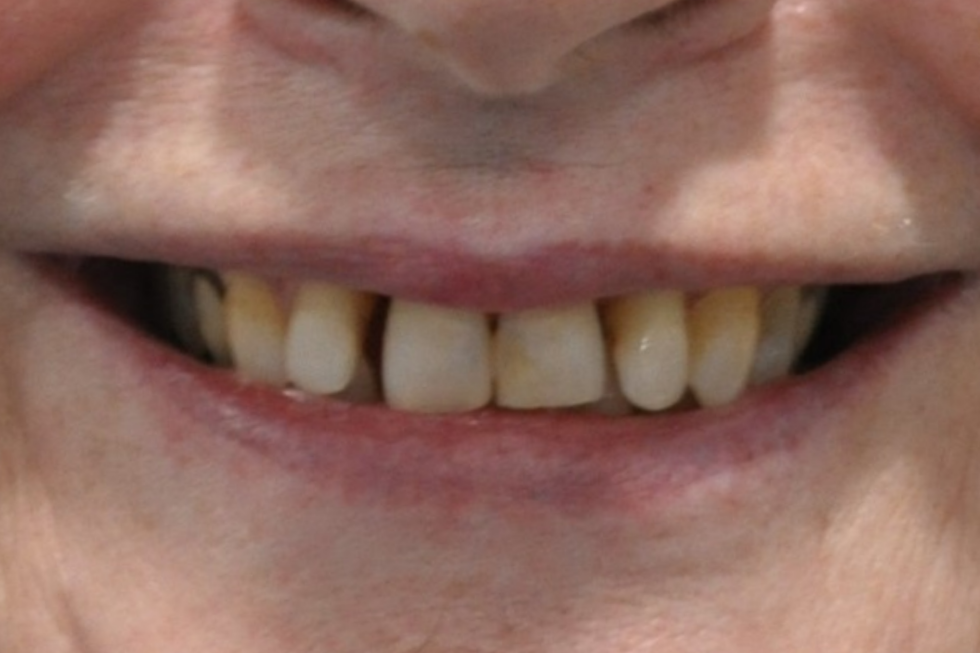 veneers pakenham