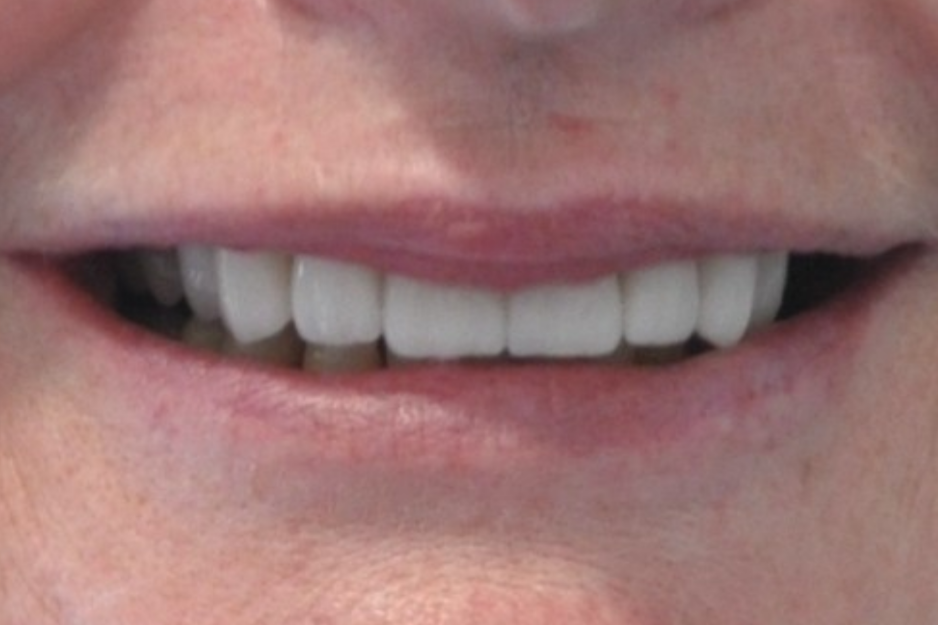 veneers pakenham