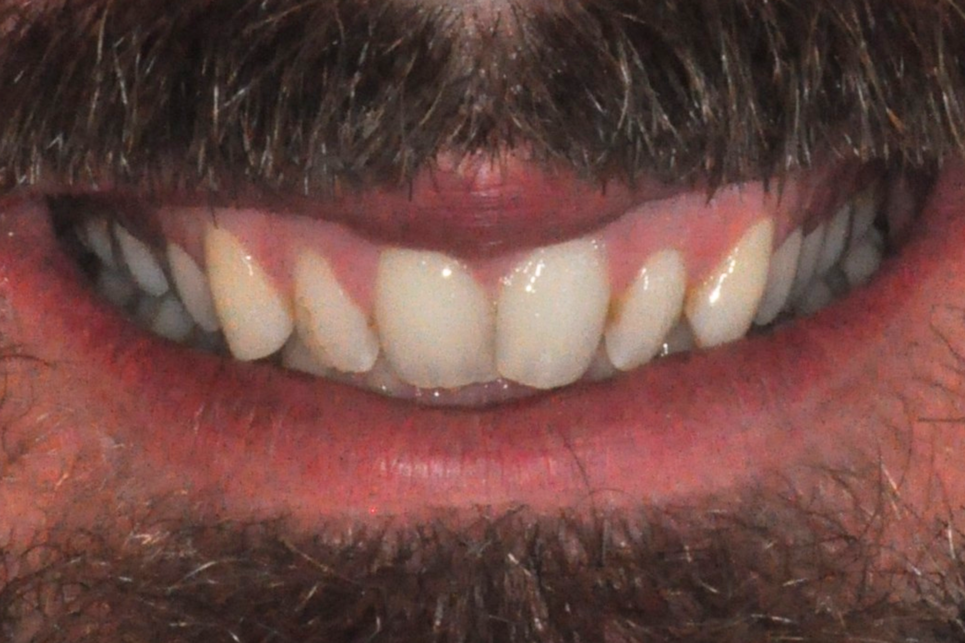 veneers pakenham